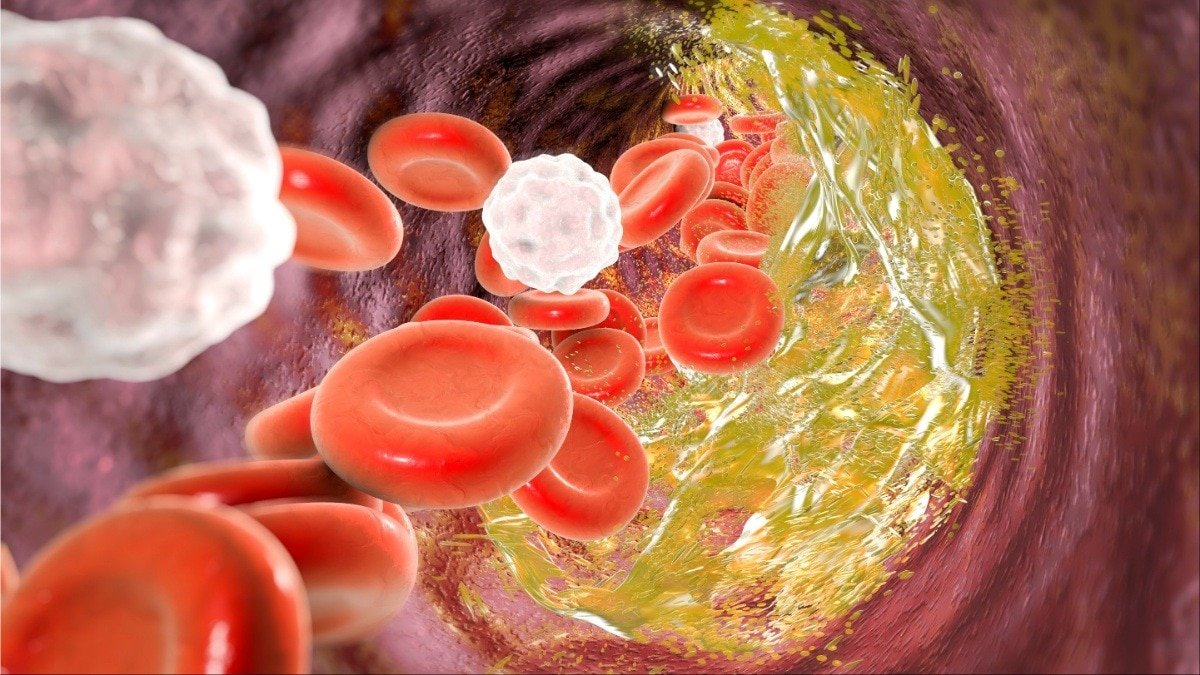 How to raise good cholesterol: Doctor shares 5 key lifestyle changes to boast HDL (Photo- Getty Image)
