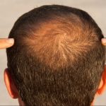 Baldness is a growing concern and nearly 40% of Indian men face hair loss before the age of 30