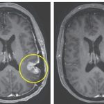 Just days after a single infusion, patients experienced notable tumour shrinkage, including one case of near-complete tumour regression. (Photo: The New England Journal of Medicine)