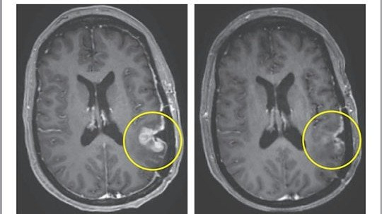 Just days after a single infusion, patients experienced notable tumour shrinkage, including one case of near-complete tumour regression. (Photo: The New England Journal of Medicine)