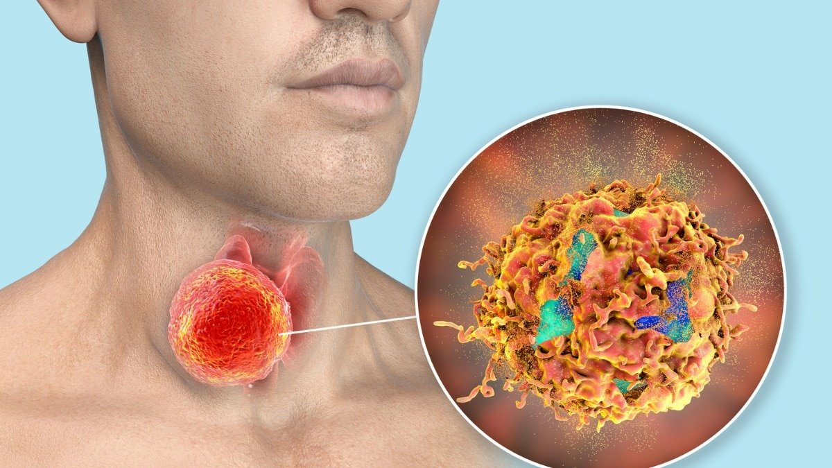 Oral sex emerging as a major cause of throat cancer in India.
