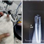 Doctors at Yashoda Medicity reattached an 18-year-old’s completely amputated hand after a construction-site accident, using a seven-hour microsurgical procedure.
