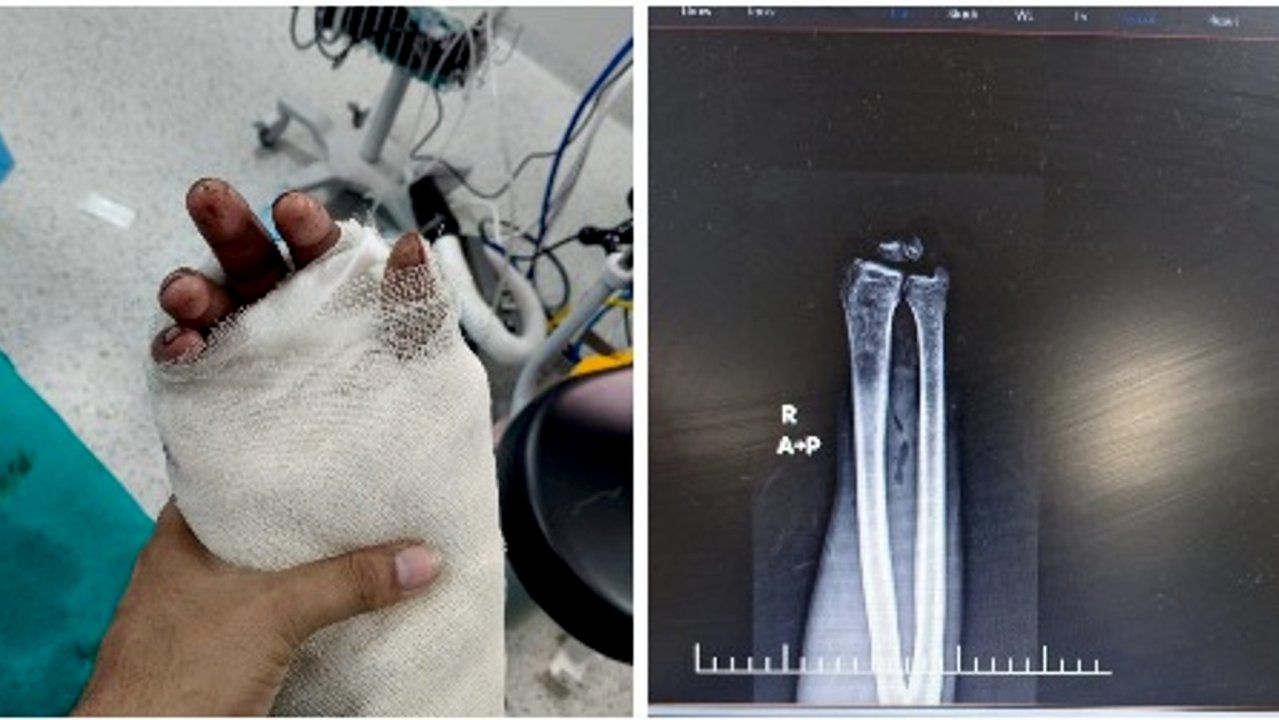 Doctors at Yashoda Medicity reattached an 18-year-old’s completely amputated hand after a construction-site accident, using a seven-hour microsurgical procedure.