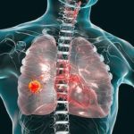 Modern therapies reshape stage 4 lung cancer