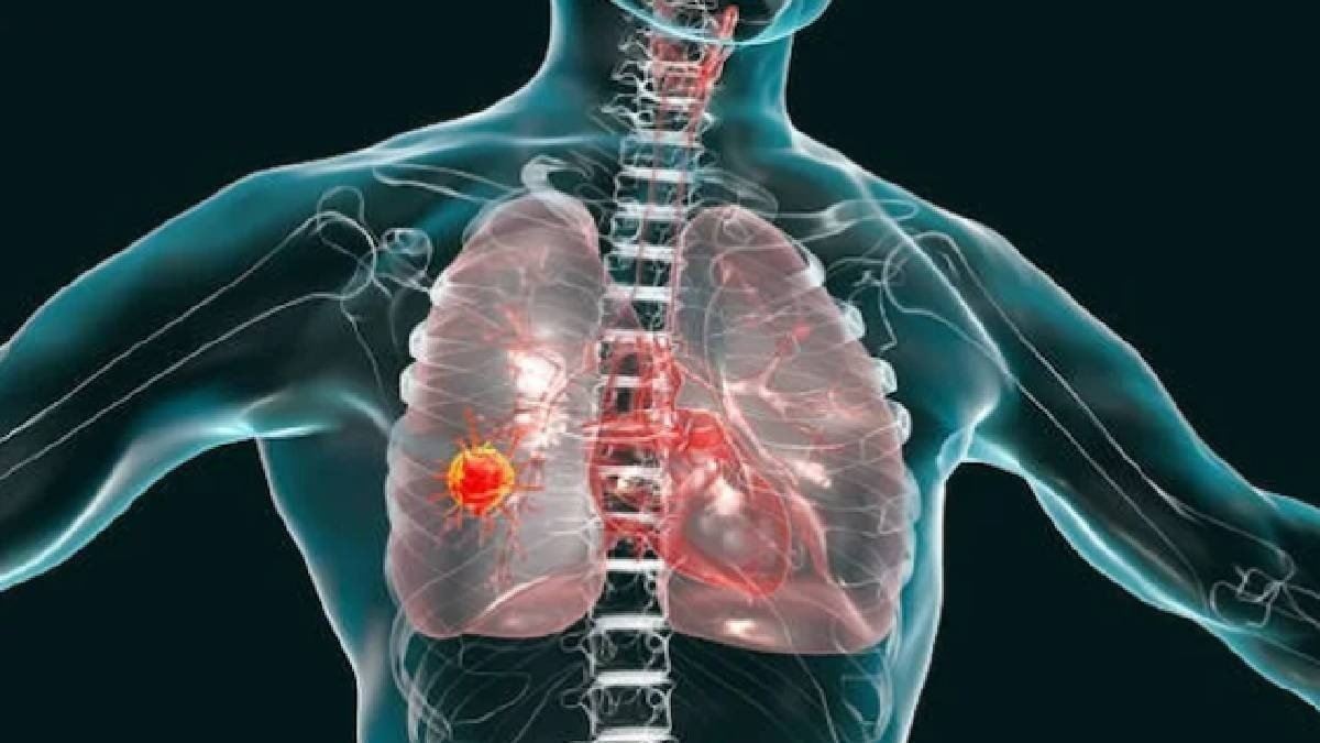 Modern therapies reshape stage 4 lung cancer