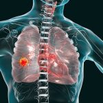 Lung cancer is now India’s deadliest cancer. More women, non-smokers in its grip