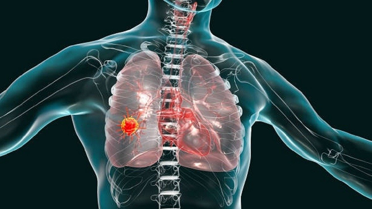 Lung cancer is now India’s deadliest cancer. More women, non-smokers in its grip