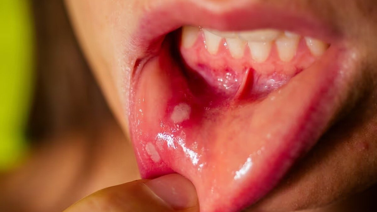Oral cancer