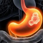 Colorectal cancer enters India’s top five cancers in GLOBOCAN 2024