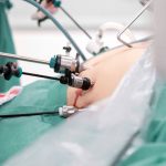 Surgeons performing bariatric surgery in operating room. Close-up of laparoscopic instruments on stomach of patient in operation theater.
