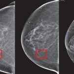 Over 2 lakh new breast cancer cases are diagnosed in India every year