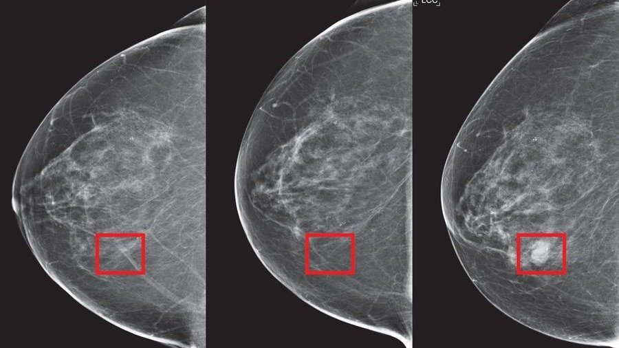Over 2 lakh new breast cancer cases are diagnosed in India every year
