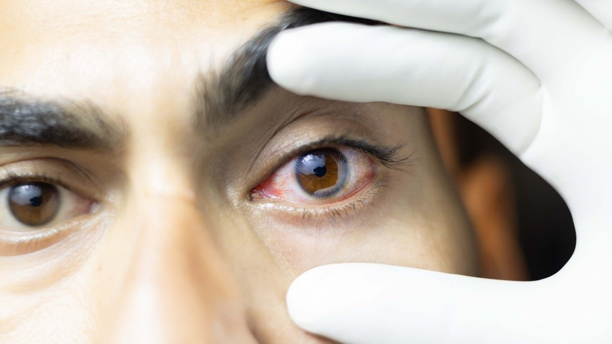 H1N1 can affect the eyes too. Watch for these warning signs as flu surges
